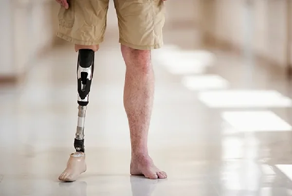 Post Amputation Phantom Pain